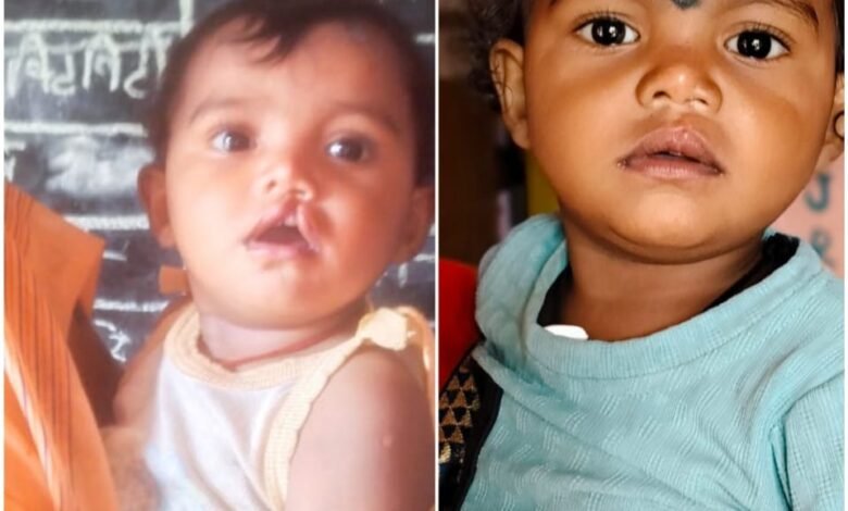 रायपुर : चिरायु दल ने लौटाई मासूम रंजना की मुस्कान