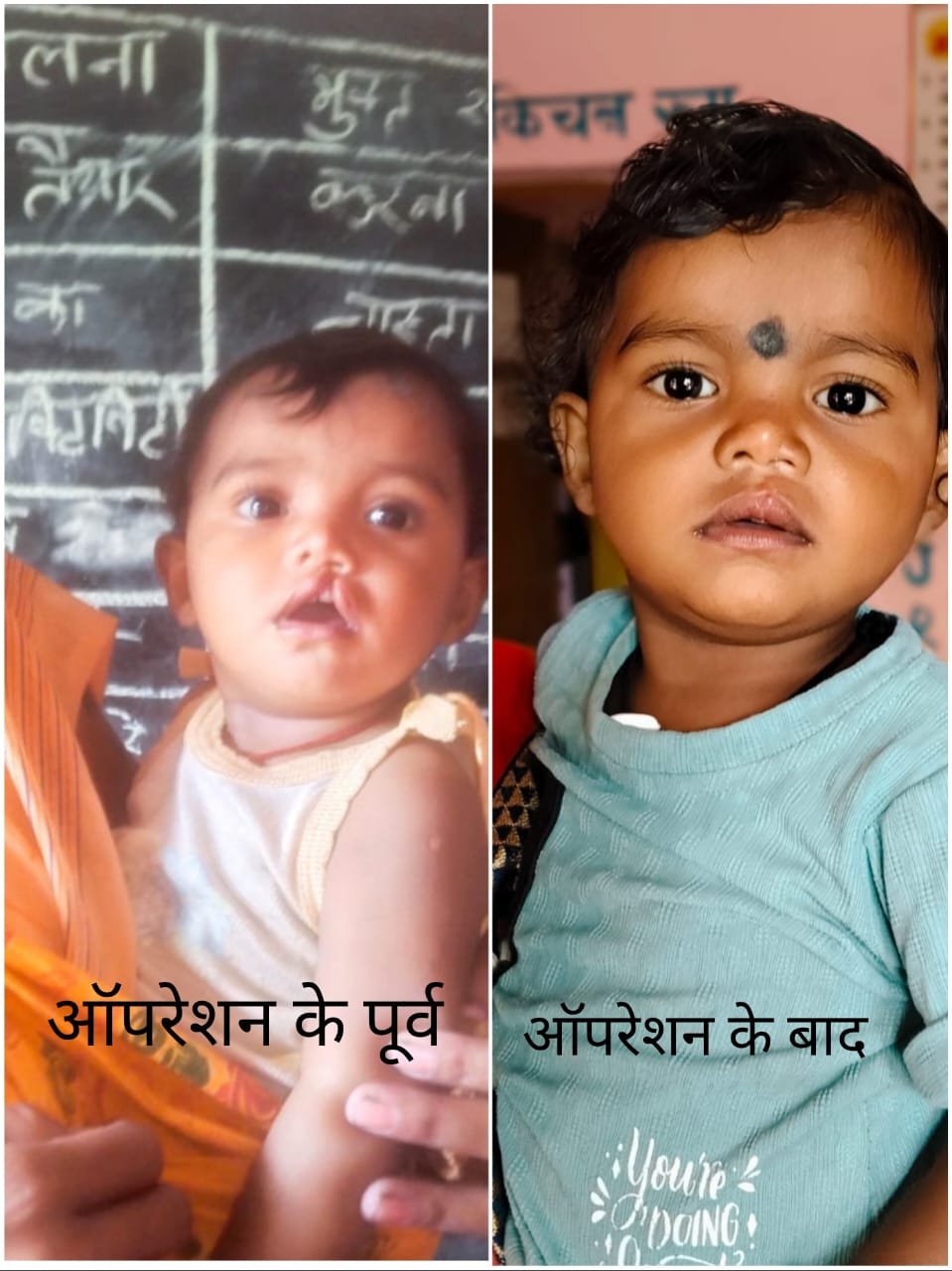 रायपुर : चिरायु दल ने लौटाई मासूम रंजना की मुस्कान