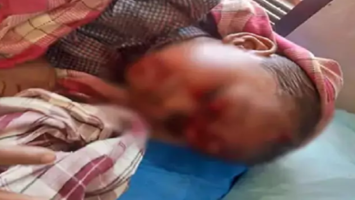 CG : 4 साल के मासूम पर आवारा कुत्ते का हमला, सिर-मुंह समेत 17 जगह गंभीर जख्म …