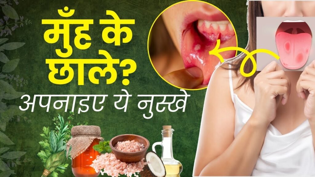 Home Remedies for Blisters