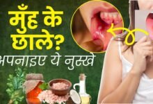 Home Remedies for Blisters