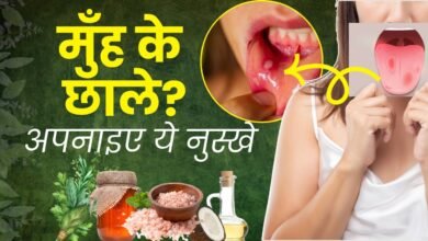 Home Remedies for Blisters