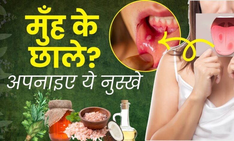 Home Remedies for Blisters