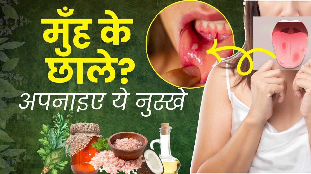 Home Remedies for Blisters